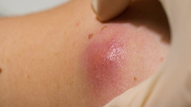 Dermatologist examines an inflamed cyst on patient's body, skin closeup macro (atheroma, sebaceous cyst) 