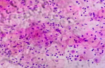 Photomicrograph of Paps smear: Inflammatory smear with HPV related changes. Cervical cancer. SCC