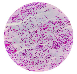 Photomicrograph of Paps smear: Inflammatory smear with HPV related changes. Cervical cancer. SCC