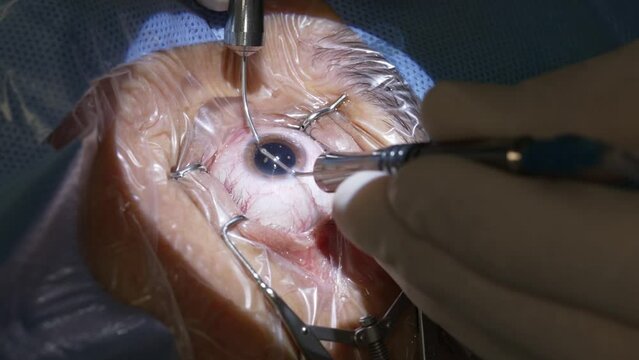Eye surgery details cataracts operation