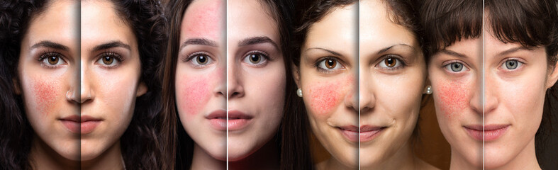 Collage of women's faces showing before and after rosacea