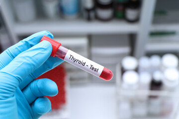 Thyroid test to look for abnormalities from blood
