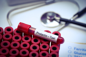 Prolactin test to look for abnormalities from blood