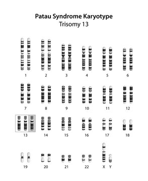 Patau syndrome (trisomy 13) human (male) karyotype	