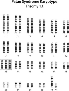 Patau syndrome (trisomy 13) human (male) karyotype