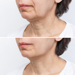 Lower part of face and neck of elderly woman with signs of skin aging before and after facelift,...