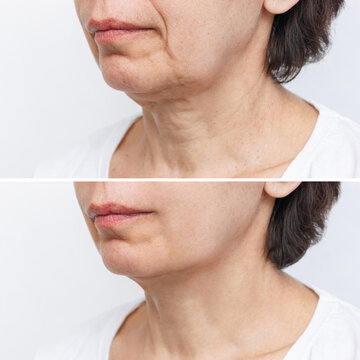 Lower part of face and neck of elderly woman with signs of skin aging before and after facelift, plastic surgery on white background. Rejuvenation of flabby sagging skin, wrinkles, creases. Comparison