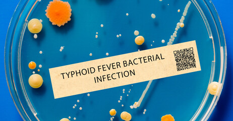 Typhoid fever - Bacterial infection that causes fever, stomach pain, and diarrhea.