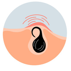 Ingrown hair. Inflammation, skin problems. Anatomy infographics of hair. Flat illustration isolated on the white background.