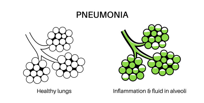 Pneumonia infection poster