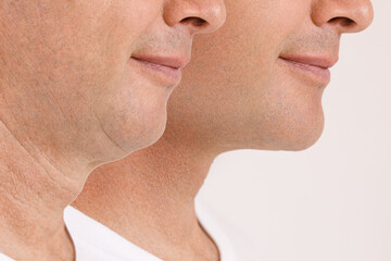 A close portrait of an aged man before and after the facial rejuvenation procedure. Correction of...