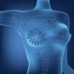 Transparent, neon female torso on a blue background with mammary glands. Conceptual medical poster. Vector illustration