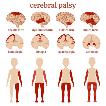 A diagram indicating the types of cerebral palsy using the example of drawings of the brain and a human figure. Conceptual medical poster. Vector illustration