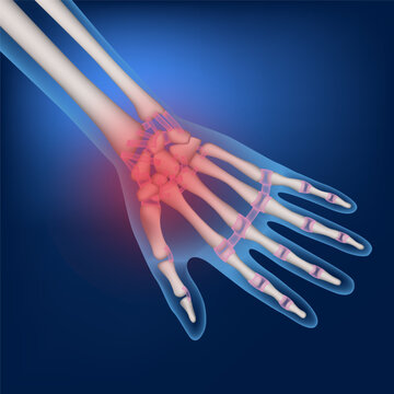 Bones of a human hand on a blue background. Inflammation of the joints. Medical poster. Vector illustration