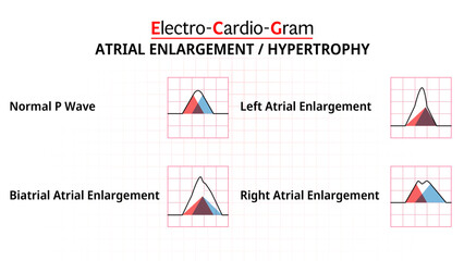 The Difference Abnormal P Wave - ECG Biatrial Enlargement, Right Atrial Erlagement, Left Atrial Enlargement - Electrocardiogram - Morphology P Wave - Vector Illustration