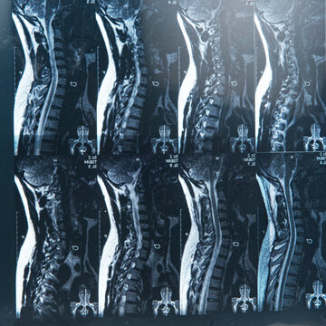 MRI xray film scan of sacro-lumbar spines of a patient with chronic back pain