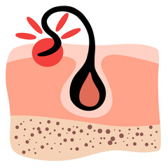 Ingrown hair. Inflammation, skin problems. Anatomy infographics of hair. Flat illustration isolated on the white background.