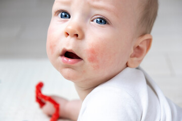 Baby face with atopic dermatitis on cheeks. Eczema. Allergy. Dry skin, rash, itch and other...