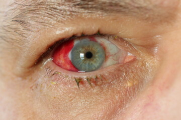 Auge rechts, nach einer OP Der Graue Star (die Katarakt) ist eine Augenerkrankung, bei der eine oder beide Augenlinsen trübe werden. 
- Augen Operation, grauer Star, Blutunterlaufen, verletzt 