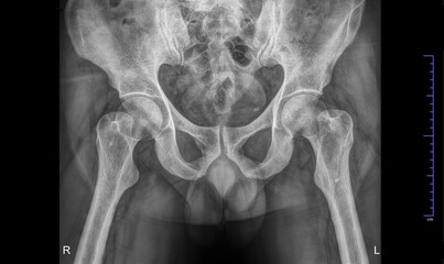 X-ray radiograph of the pelvis and hips of a man
