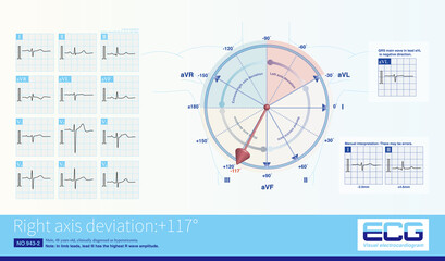 The right axis deviation can be seen in patients with right ventricular hypertrophy, patients with severe left ventricular disease (left ventricular myocardial loss), and some normal individuals.