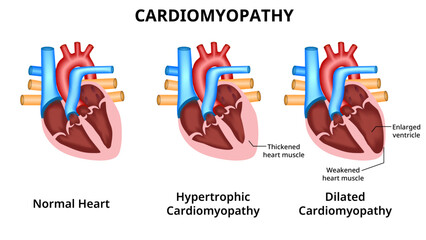 Types of heart diseases: hypertrophic cardiomyopathy and dilated cardiomyopathy. healthy heart and heart with Pathology. vector illustration for medical use