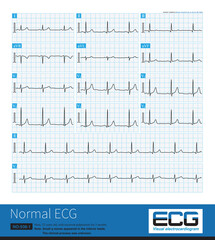 Sometimes, in middle-aged people, small q waves appear in inferior leads of the electrocardiogram, and it is necessary to distinguish between physiological and old inferior myocardial infarction.
