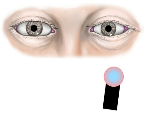 the swing flashlight lest or relative afferent pupillary light  defect (RAPD).