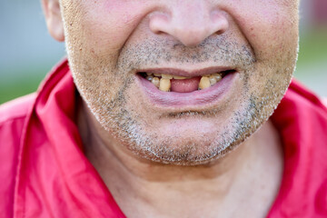 Toothless Caucasian middle aged man, lower part of face close up.