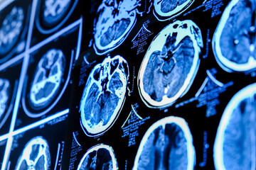 Close-up of CT scan with brain. Medicine, science and education MRI brain background. Magnetic resonance imaging. Tomography shot.