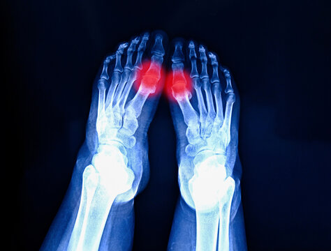 Film x-ray foot radiograph show pain area with red, isolated on dark background. Shoe wearing and cosmetic problems.