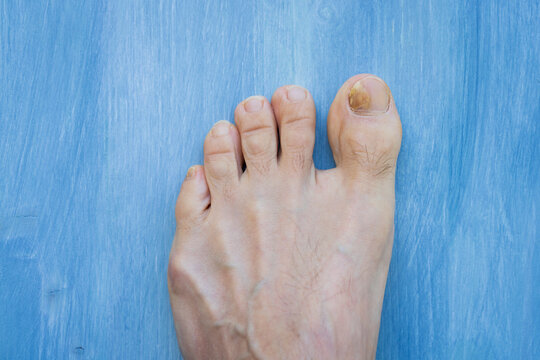 Fungal Nail Infection. Onychomycosis or tinea unguium. Four