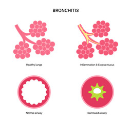 Bronchitis lung disease