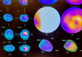 Color adenosine cardiac stress test images on black background