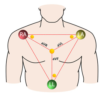 Augmented Limb Leads ECG - Einthoven Triangle - Electrocardiogram - Medical Vector Illustration