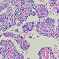 Camera photo of a papillary thyroid carcinoma, showing characteristic Orphan Annie-eyed nuclear...
