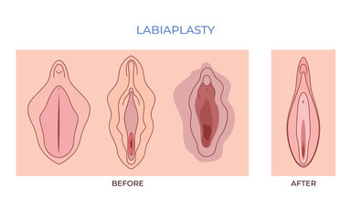 Labiaplasty. vaginoplasty. women genital of minor Vulval labia loose lips beauty surgery to tighten - obrazy, fototapety, plakaty