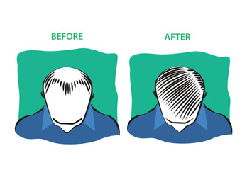Hair Loss Treatment Before and After diagram. Editable Clip Art