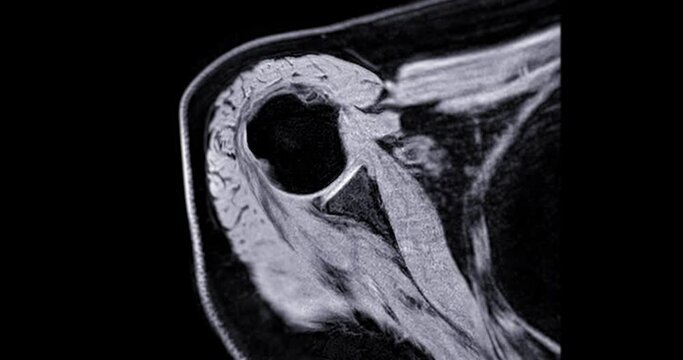 Magnetic Resonance Imaging or MRI of Shoulder Joint for diagnostic shoulder pain.