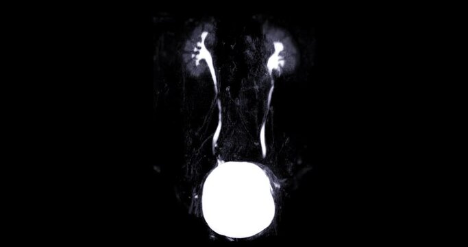 Magnetic resonance urography (MR urography) is a MRI study that predominantly used to image congenital abnormalities of the urinary system. 