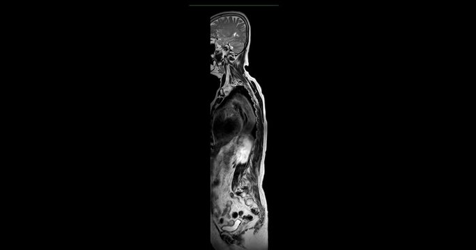 MRI Screening whole spine sagittal view  for diagnosis  compress spinal cord ( Myelopathy ) .