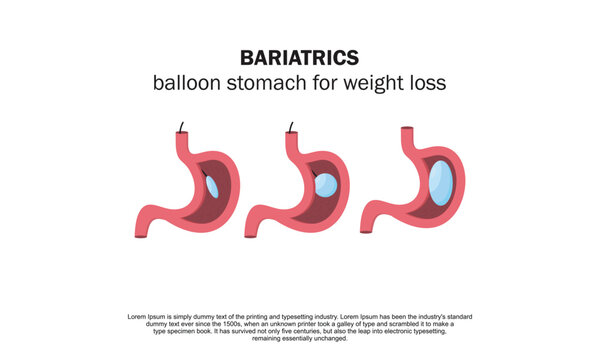 Stomach With Adjustable Gastric Band Device. Bariatric Surgery Weight Loss Procedure. Stomach Reduction Anatomical Diagram Infographic. Health Care Medical Concept. Vector Illustration