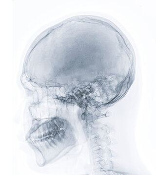  x-ray image of Human Skull   lateral view for diagnosis skull fracture  isolated on Black Background.