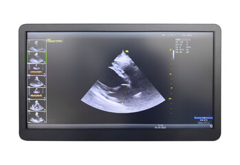 Ultrasound image on the monitor close-up. Ultrasound scan examination on display. Screening ultrasonography analysis. Echocardiography