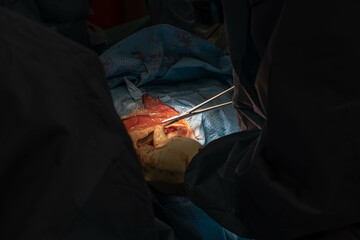 Hip Surgery - Closing the Wound with Surgical Stitches