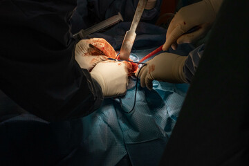 Hip Surgery in Progress: Detailed Footage of Surgeons in the Operating Room