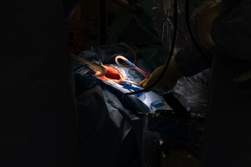 Hip Surgery in Progress: Detailed Footage of Surgeons in the Operating Room