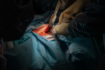 Hip Surgery in Progress: Detailed Footage of Surgeons in the Operating Room