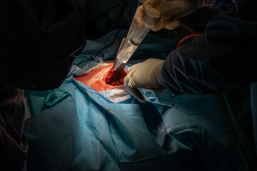 Hip Surgery in Progress: Detailed Footage of Surgeons in the Operating Room