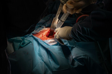 Hip Surgery in Progress: Detailed Footage of Surgeons in the Operating Room
